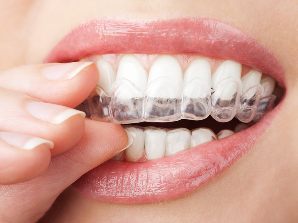 Quels sont les dangers d'un blanchiment dentaire ?