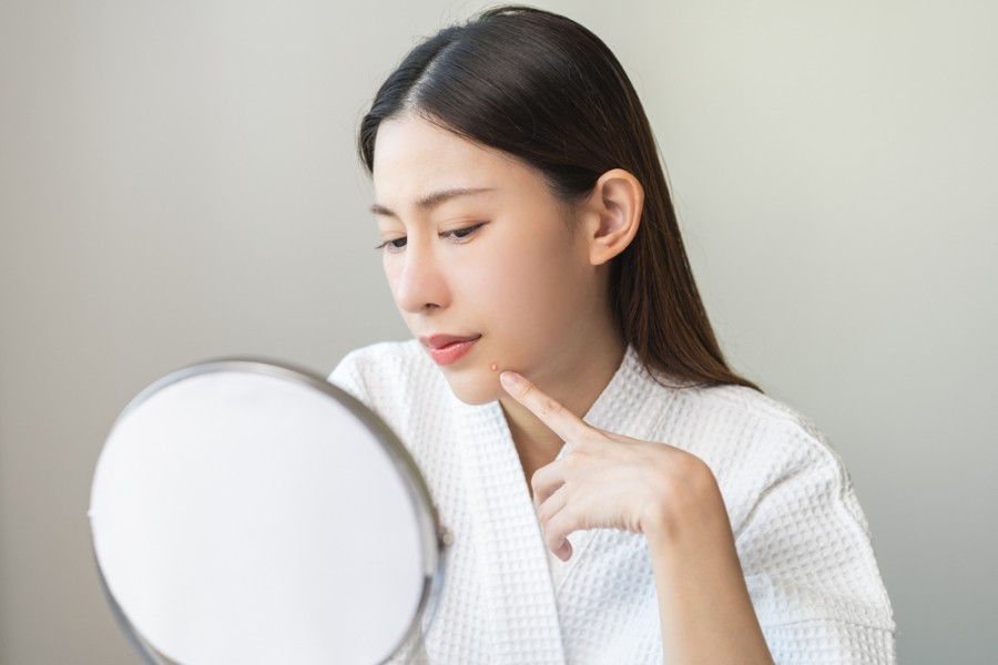 Les boutons autour de la bouche : causes et traitement