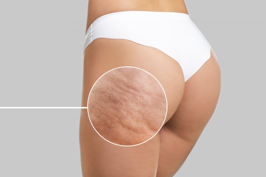 Cellulite aqueuse : un symptôme de la rétention d'eau