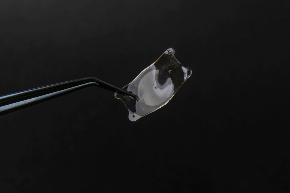 Comment se déroule une pose d'implant de cataracte ?