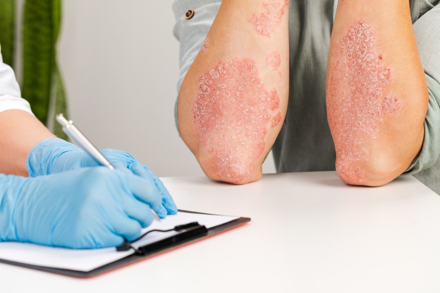 Comment soigner l'eczéma ?