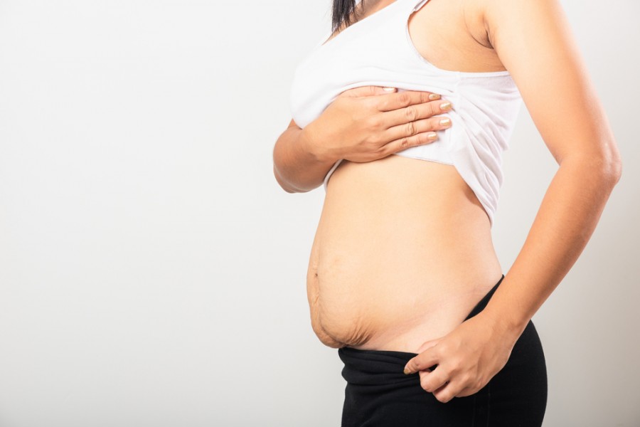 Ventre après grossesse : comment en prendre soin ? - Clinique de Vinci
